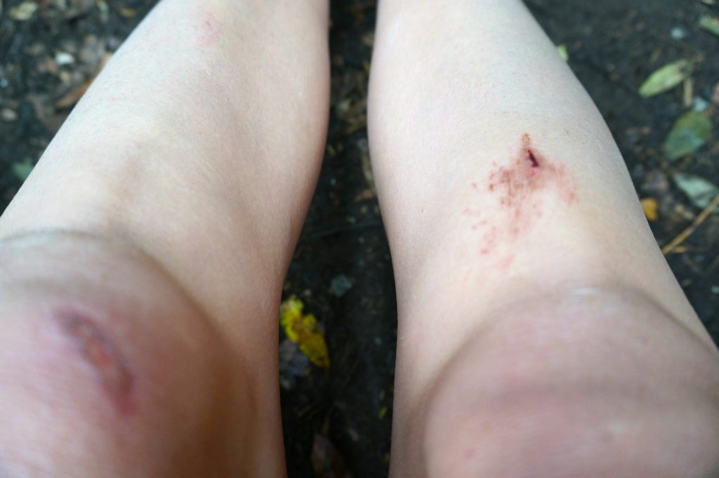 Injuries while hiking Arco Iris